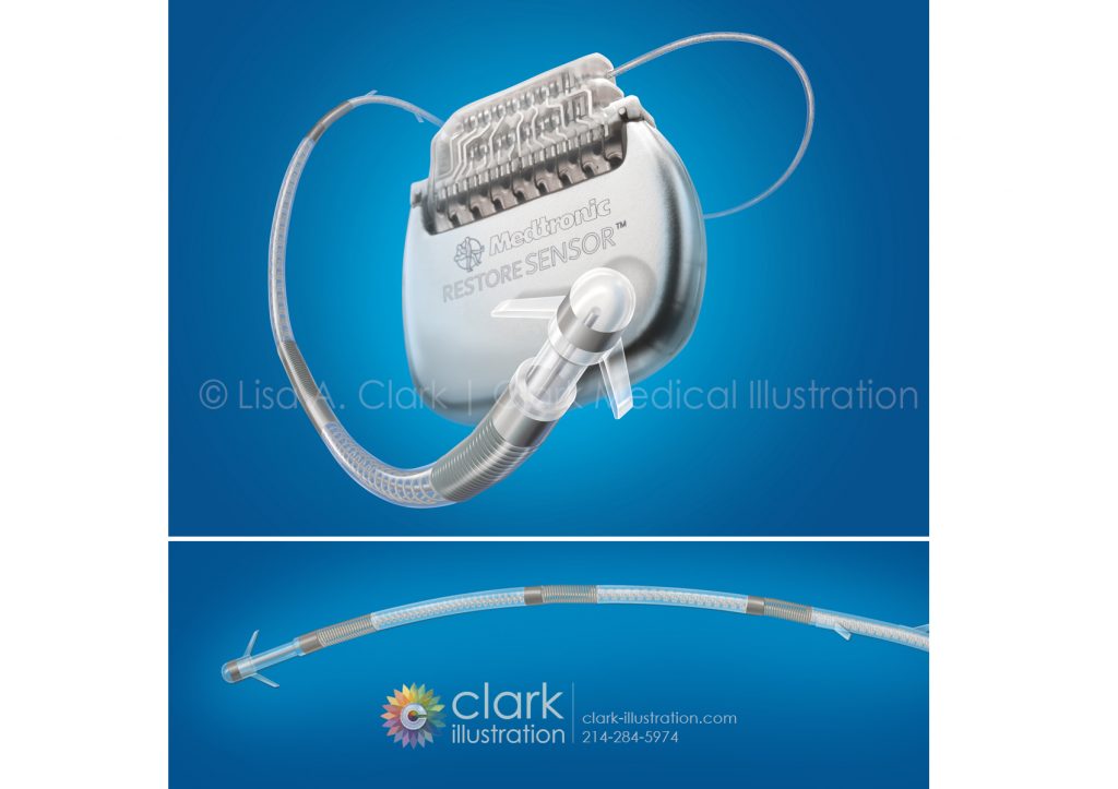 Medtronic Ankerstim™ Occipital Nerve Stimulation Device | © Lisa A. Clark