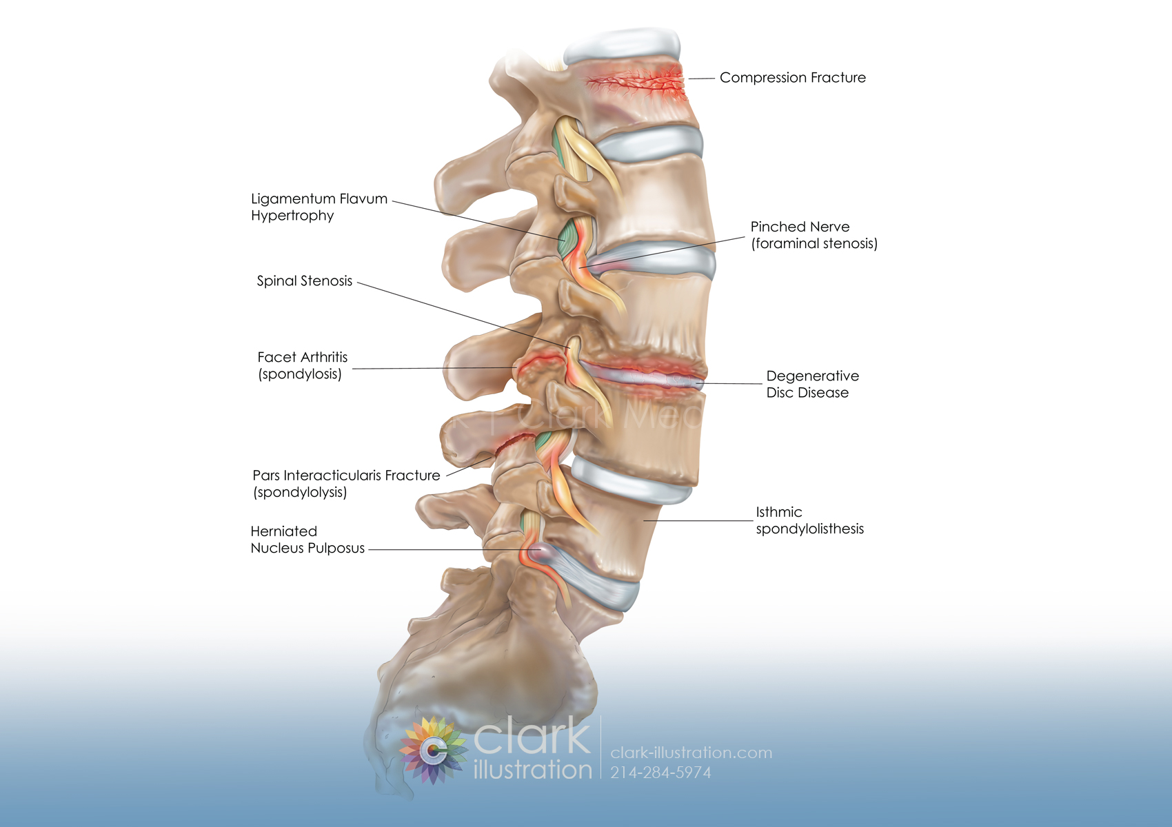 Spinal Conditions | Clark Medical Illustration