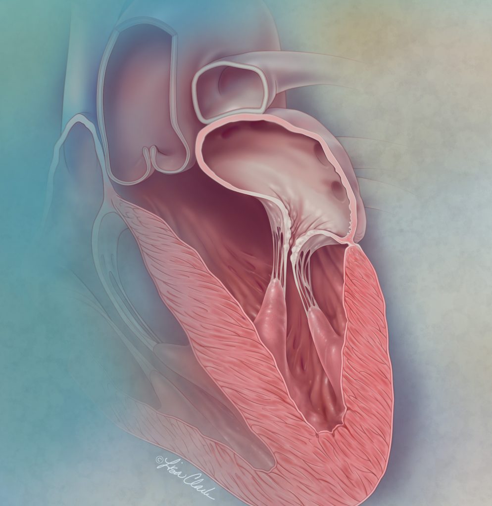 Secondary Mitral Regurgitation | © Lisa A. Clark