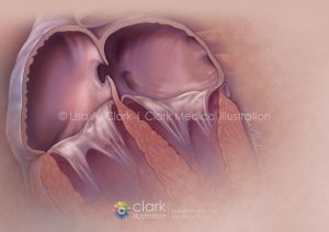 Patent Foramen Ovale (PFO) Closure | Clark Medical Illustration