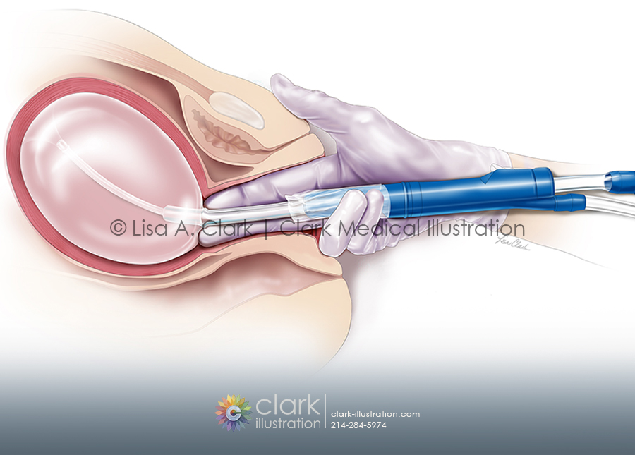 Balloon Tamponade Device Medical Illustration