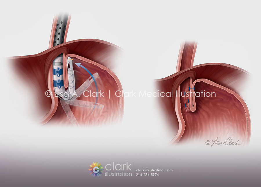 Esophagogastric Fundoplication Illustration