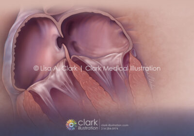 Patent Foramen Ovale (PFO) Illustration