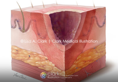Burn Zones - Clark Medical Illustration Burn zones illustration