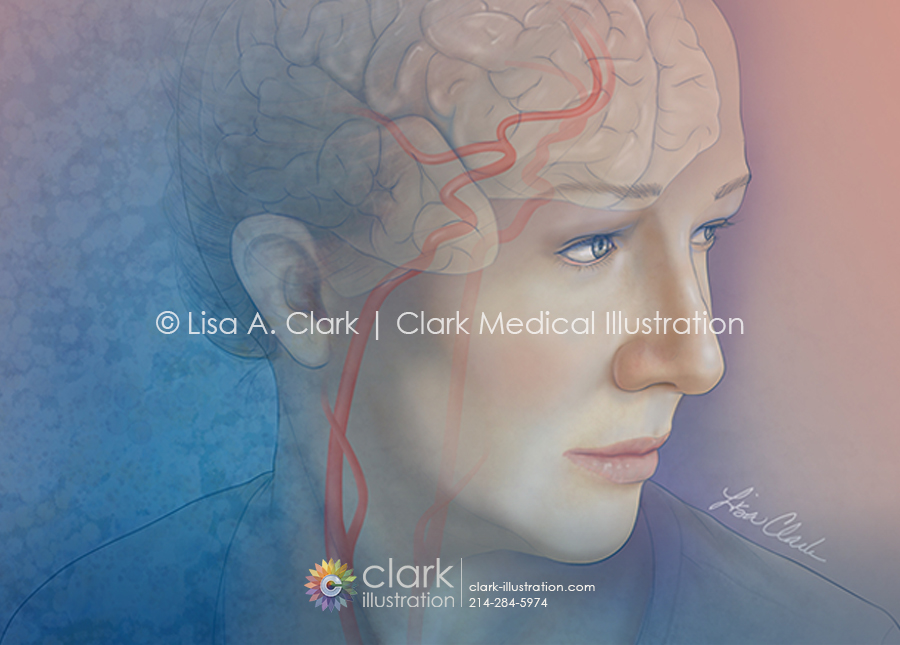 Carotid and Cerebral Artery Illustration