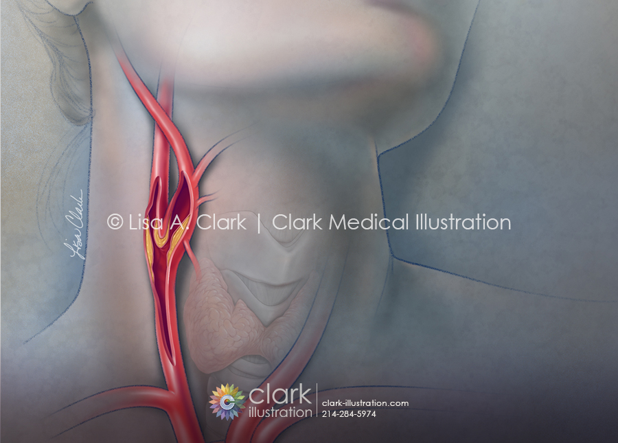 Carotid Stenosis Illustration