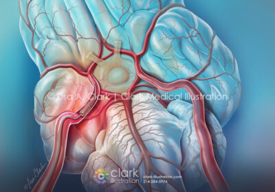 Endovascular Thrombectomy Illustration