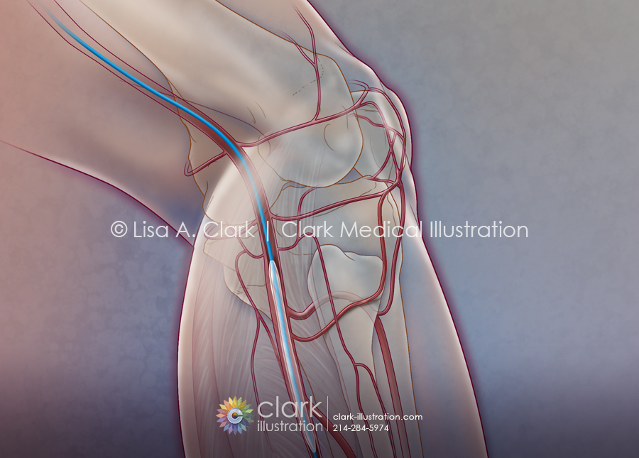 Angioplasty for Peripheral Artery Disease (PAD) Illustration
