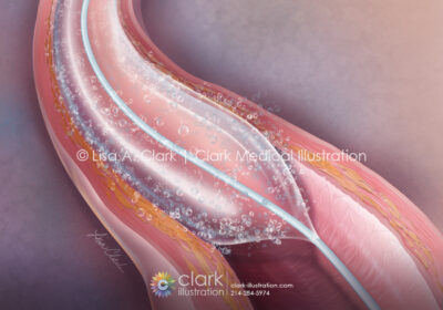 Drug-Coated Balloon Angioplasty Illustration