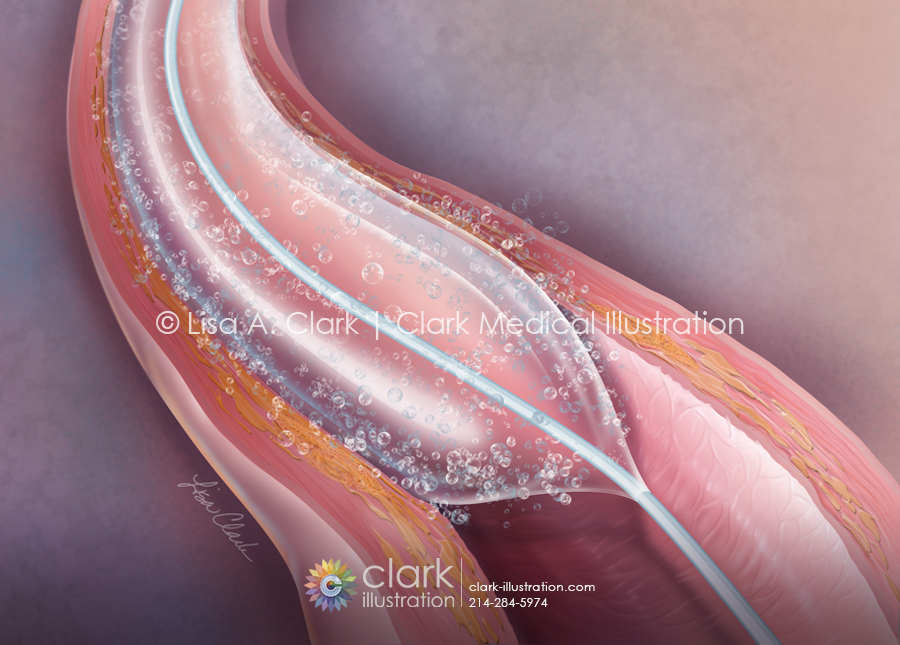 Drug-Coated Balloon Angioplasty Illustration