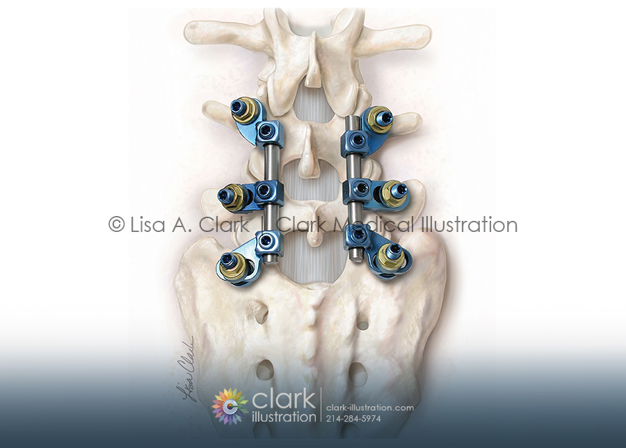 Lumbar Spinal Implant Illustration