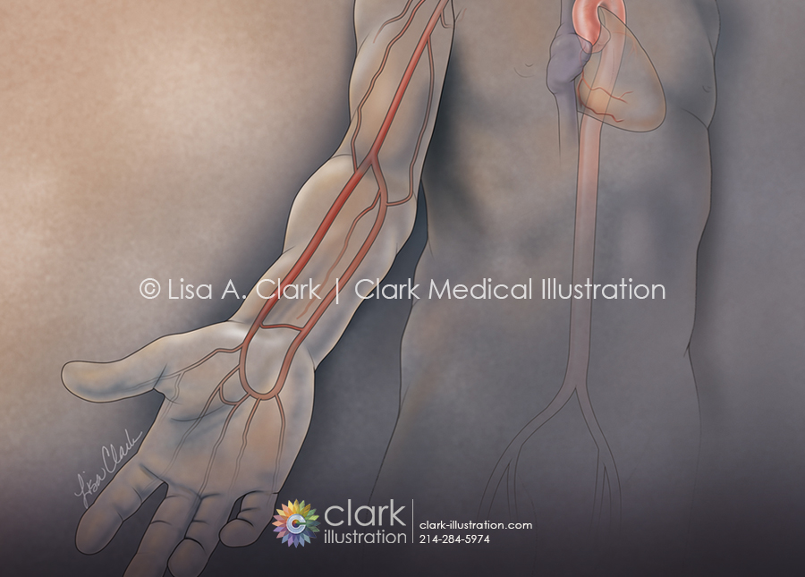 Radial Artery Access for Cardiac Catheterization Illustration