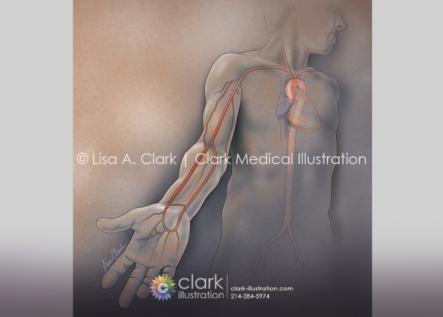 Radial Artery Access for Cardiac Catheterization