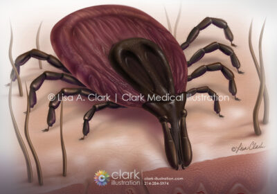 Tick medical illustration