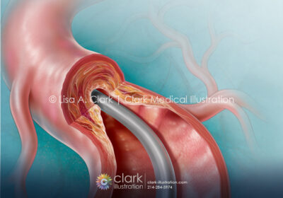 Catheter-Directed Atherectomy Illustration