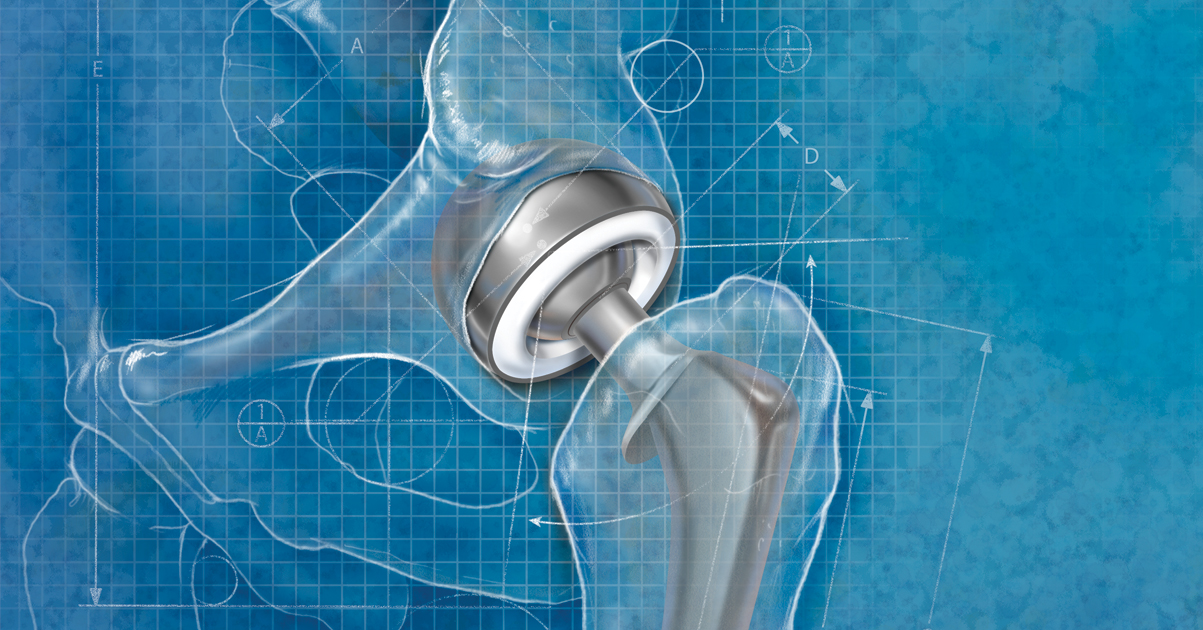 Hip Replacement Blueprint