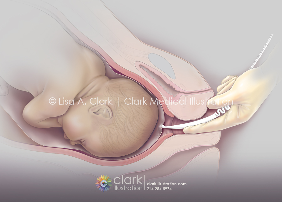 Amniotic Membrane Perforator Illustration