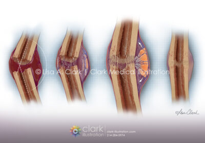 Bone Fracture Healing Illustration