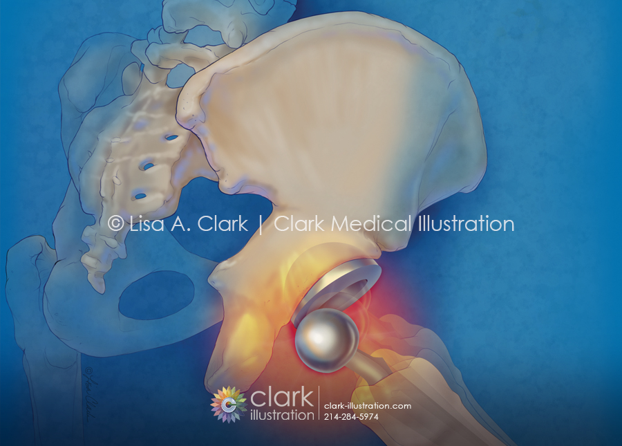 Hip Replacement Dislocation Illustration
