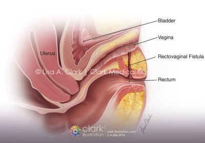 Rectovaginal Fistula Illustration