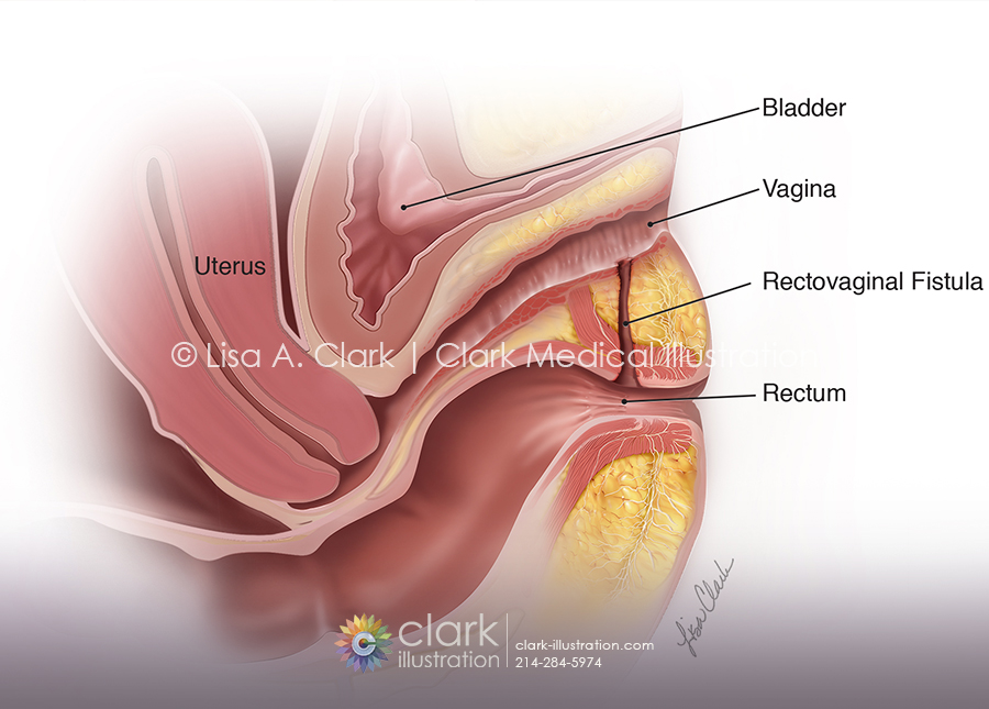 Rectovaginal Fistula Illustration