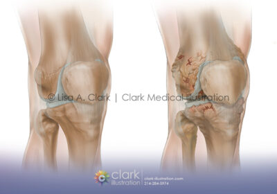 Osteoarthritis Progression
