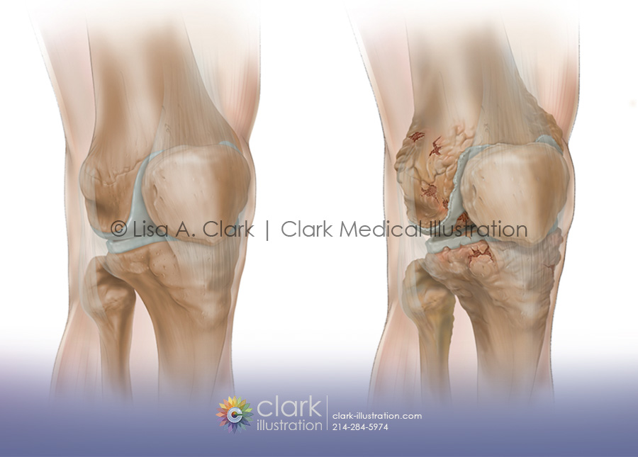 Osteoarthritis Progression