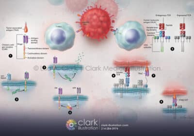 CAR-T and TCR Therapies - Clark Medical Illustration CAR-T and TCR Therapies Illustration