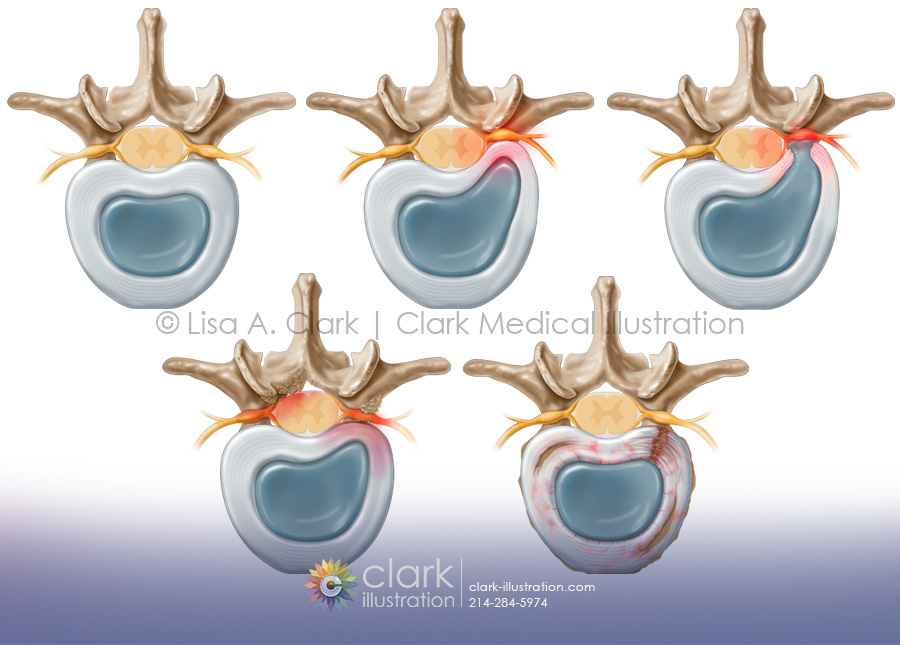 Vertebral Disc Disease illustration